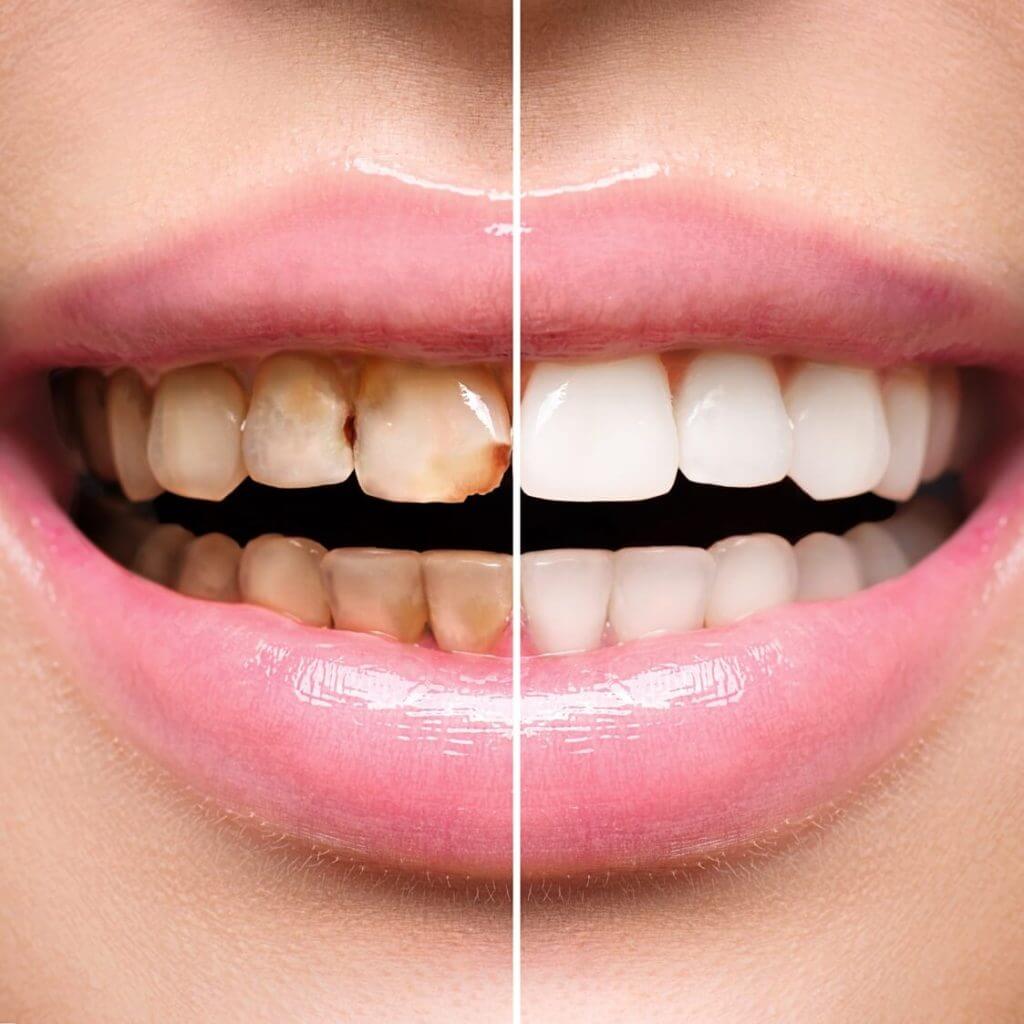 Chipped Teeth Restorations