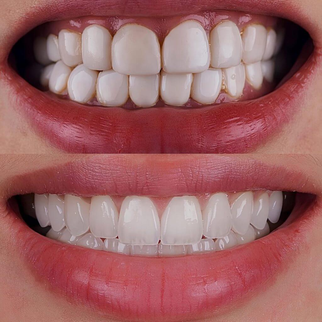 Teeth Whitening