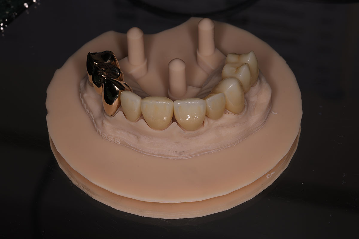 What Is a Dental Crown?