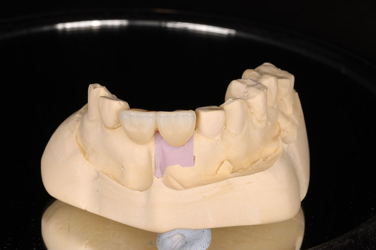 CEREC Same-Day Crowns vs Traditional Crowns