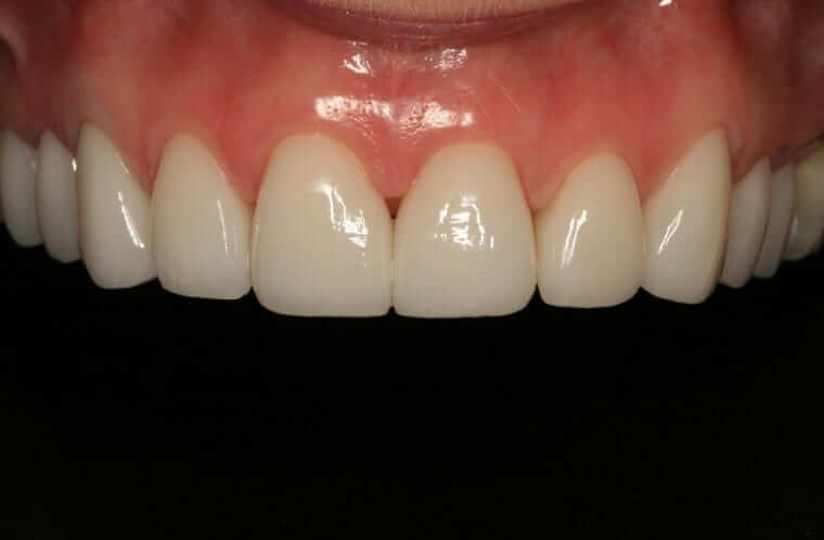 Porcelain vs Composite Veneers: Which Is Right for You?